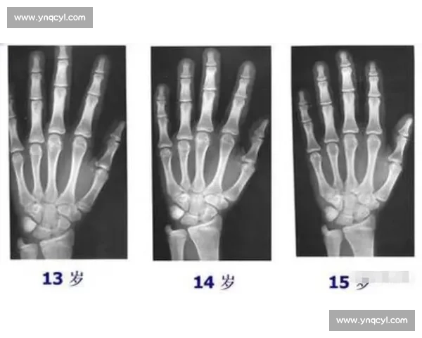 18 岁骨骺线未闭合?科学 3 招助你再长高 5cm 18 岁骨骺线未闭合?科学 3 招助你再长高 5cm